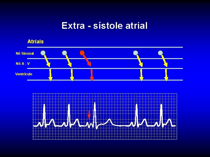 Extra - sístole atrial Atriais Nó Sinusal Nó A - V Ventrículo 