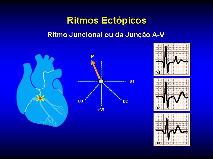 Ritmos Ectópicos Ritmo Juncional ou da Junção A-V P D 1 D 3 D