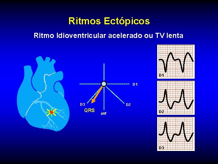 Ritmos Ectópicos Ritmo Idioventricular acelerado ou TV lenta D 1 D 3 QRS D