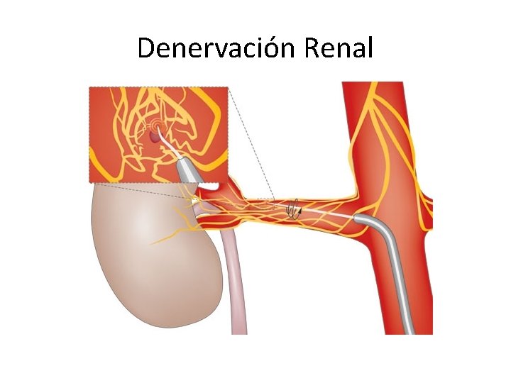 Denervación Renal Denervación Renal
