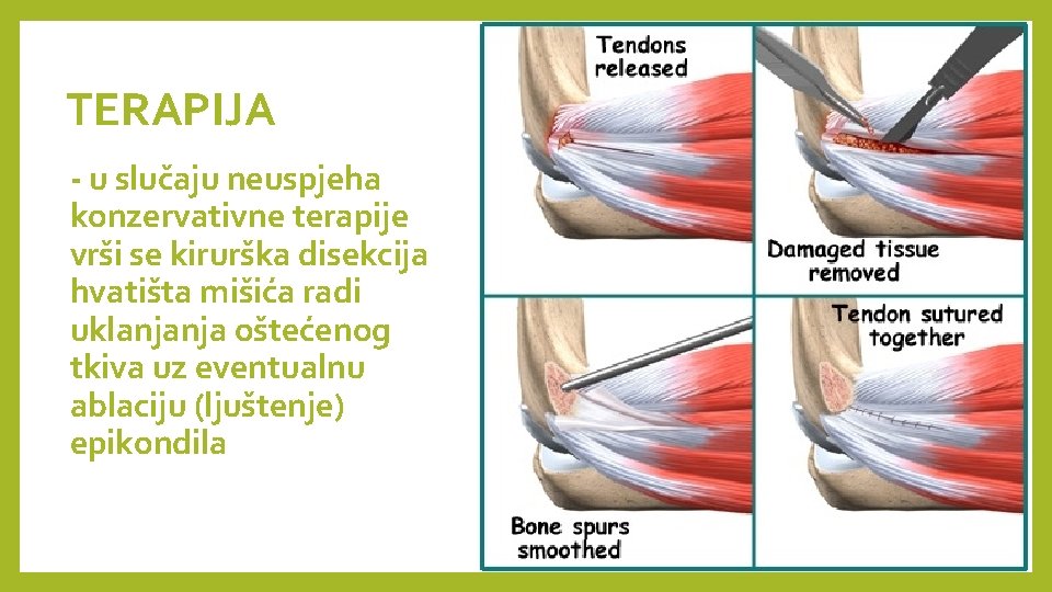 TERAPIJA - u slučaju neuspjeha konzervativne terapije vrši se kirurška disekcija hvatišta mišića radi TERAPIJA - u slučaju neuspjeha konzervativne terapije vrši se kirurška disekcija hvatišta mišića radi