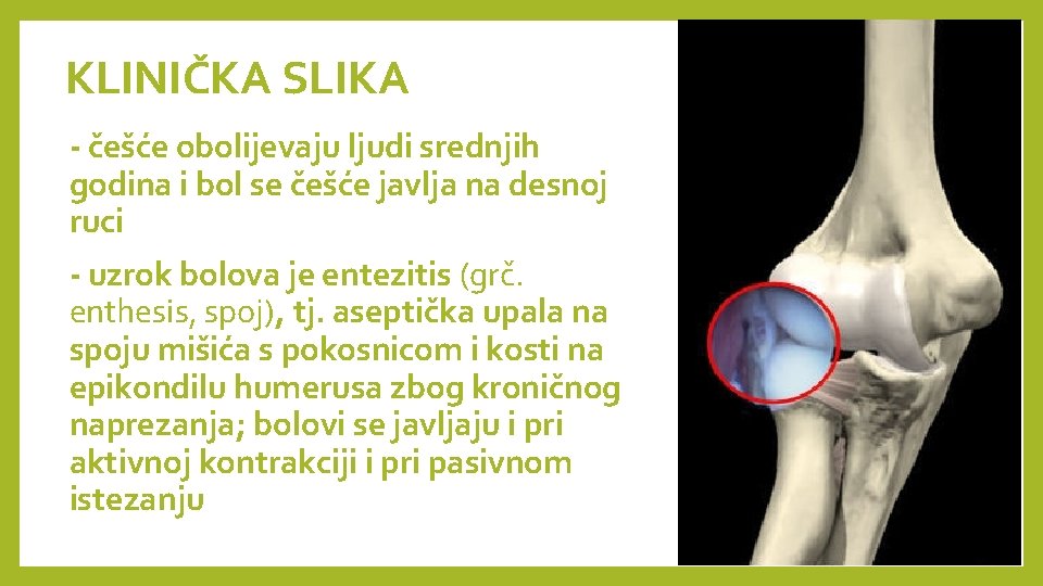 KLINIČKA SLIKA - češće obolijevaju ljudi srednjih godina i bol se češće javlja na KLINIČKA SLIKA - češće obolijevaju ljudi srednjih godina i bol se češće javlja na