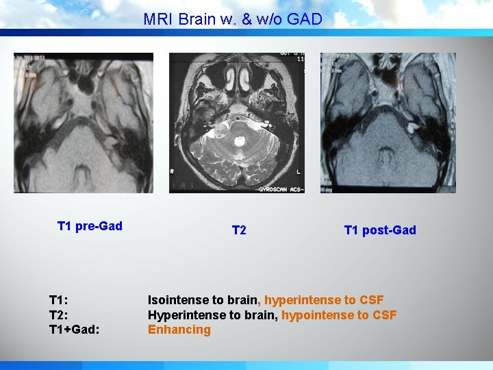 MRI Brain w. & w/o GAD T 1 pre-Gad T 1: T 2: T