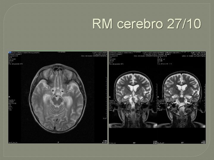 RM cerebro 27/10 RM cerebro 27/10