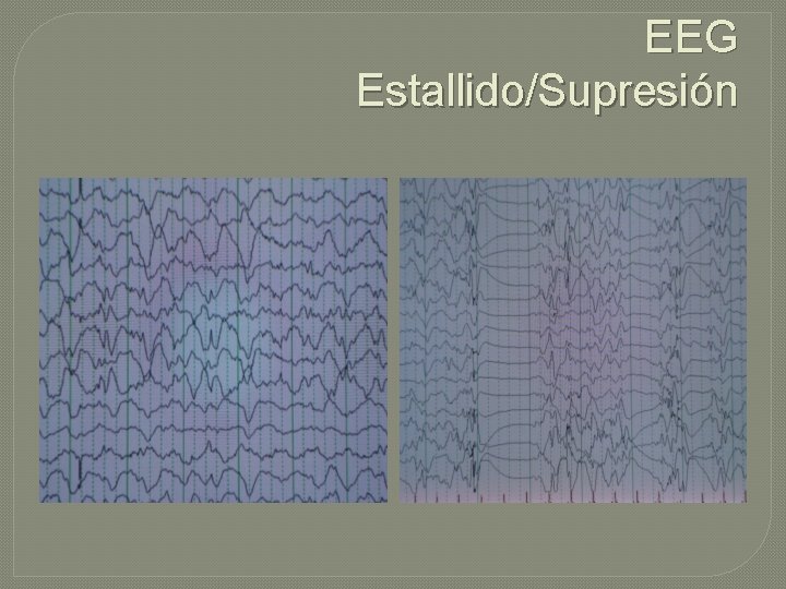 EEG Estallido/Supresión EEG Estallido/Supresión