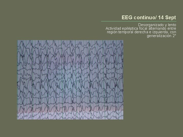 EEG continuo/ 14 Sept Desorganizado y lento Actividad epiléptica focal alternando entre región temporal EEG continuo/ 14 Sept Desorganizado y lento Actividad epiléptica focal alternando entre región temporal