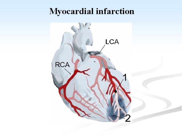 Myocardial infarction 