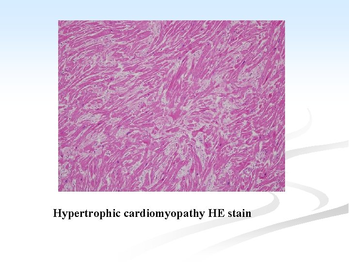 Hypertrophic cardiomyopathy HE stain 