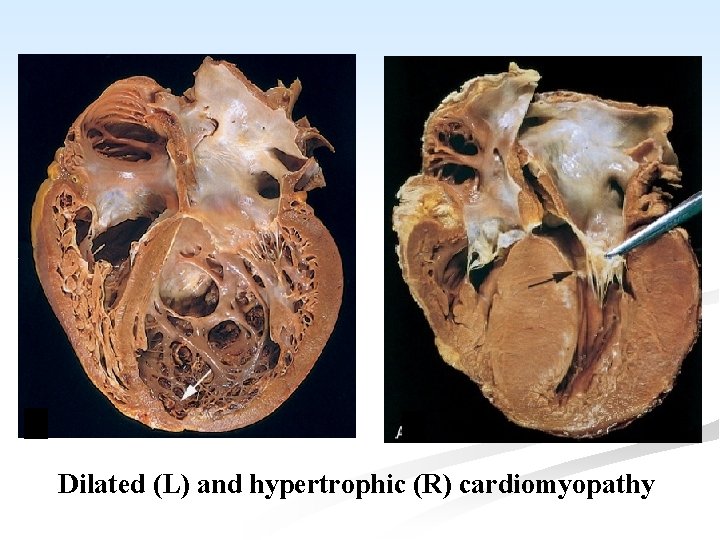 Dilated (L) and hypertrophic (R) cardiomyopathy 