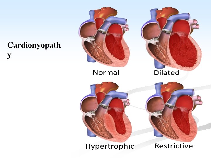 Cardionyopath y 