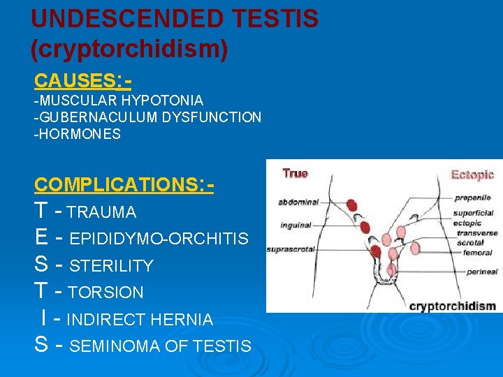 UNDESCENDED TESTIS (cryptorchidism) CAUSES: -MUSCULAR HYPOTONIA -GUBERNACULUM DYSFUNCTION -HORMONES COMPLICATIONS: - TRAUMA E -