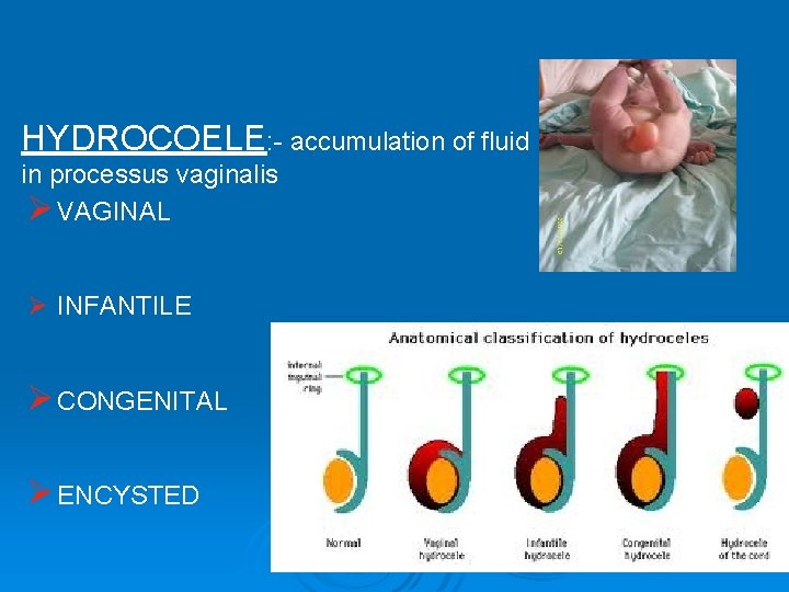 HYDROCOELE: - accumulation of fluid in processus vaginalis Ø VAGINAL Ø INFANTILE Ø CONGENITAL