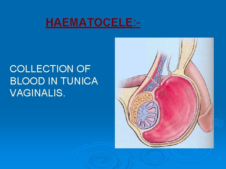 HAEMATOCELE: - COLLECTION OF BLOOD IN TUNICA VAGINALIS. 