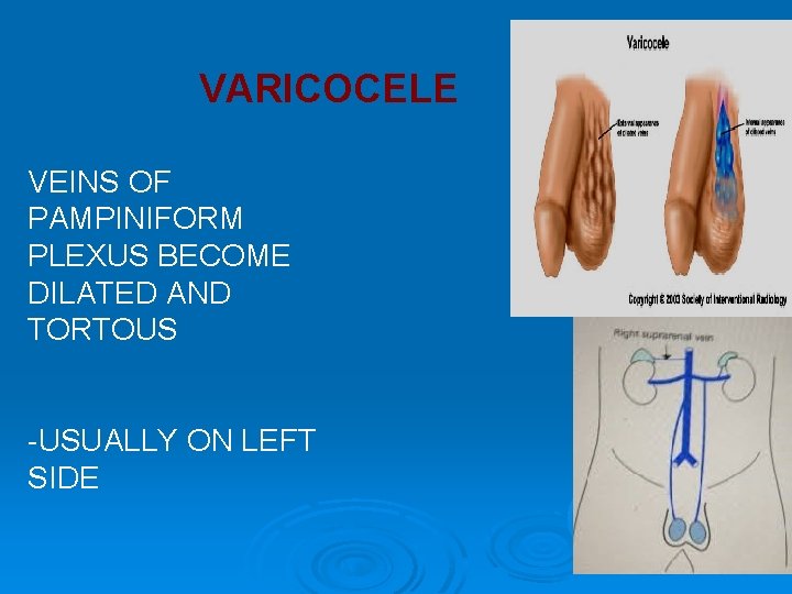 VARICOCELE VEINS OF PAMPINIFORM PLEXUS BECOME DILATED AND TORTOUS -USUALLY ON LEFT SIDE 