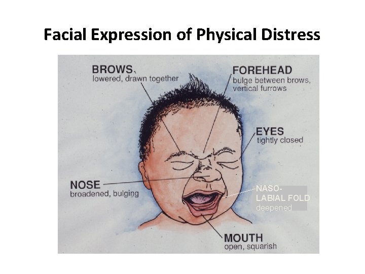 Facial Expression of Physical Distress NASOLABIAL FOLD deepened 