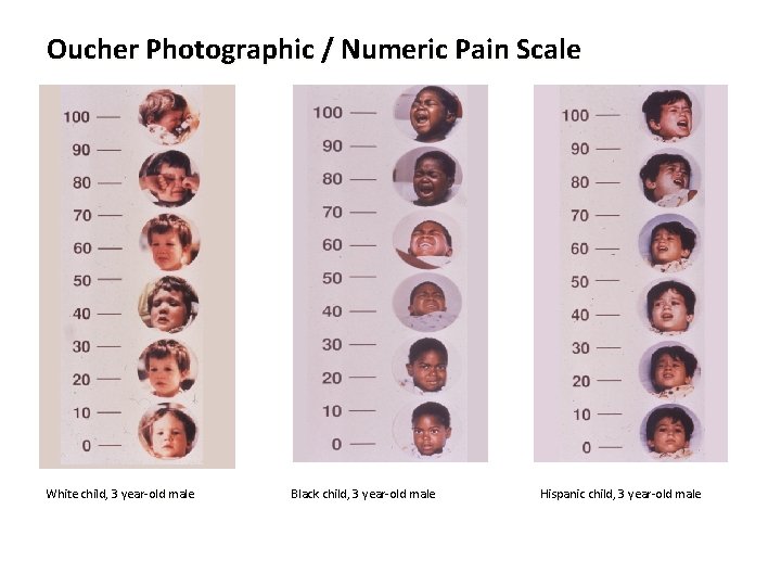 Oucher Photographic / Numeric Pain Scale White child, 3 year-old male Black child, 3