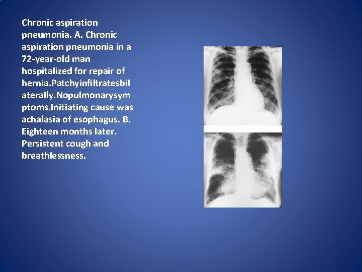 Chronic aspiration pneumonia. A. Chronic aspiration pneumonia in a 72 -year-old man hospitalized for Chronic aspiration pneumonia. A. Chronic aspiration pneumonia in a 72 -year-old man hospitalized for