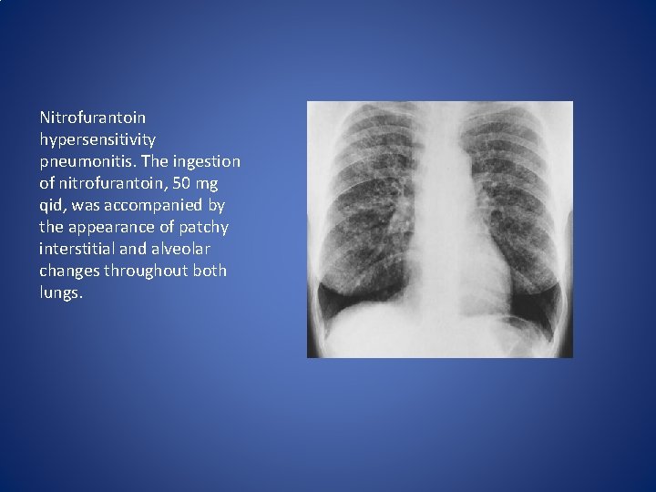 Nitrofurantoin hypersensitivity pneumonitis. The ingestion of nitrofurantoin, 50 mg qid, was accompanied by the Nitrofurantoin hypersensitivity pneumonitis. The ingestion of nitrofurantoin, 50 mg qid, was accompanied by the