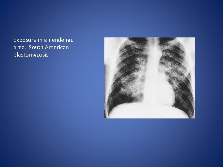 Exposure in an endemic area. South American blastomycosis. Exposure in an endemic area. South American blastomycosis.
