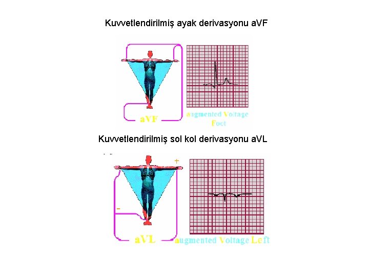 Kuvvetlendirilmiş ayak derivasyonu a. VF Kuvvetlendirilmiş sol kol derivasyonu a. VL 