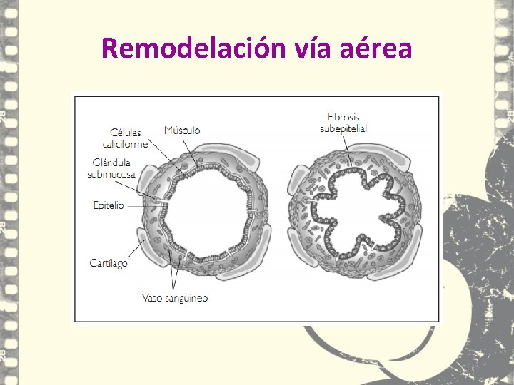 Remodelación vía aérea Remodelación vía aérea