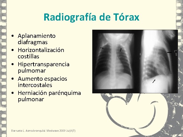Radiografía de Tórax • Aplanamiento diafragmas • Horizontalización costillas • Hipertransparencia pulmomar • Aumento Radiografía de Tórax • Aplanamiento diafragmas • Horizontalización costillas • Hipertransparencia pulmomar • Aumento