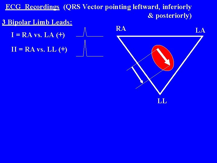 ECG Recordings (QRS Vector pointing leftward, inferiorly & posteriorly) 3 Bipolar Limb Leads: RA