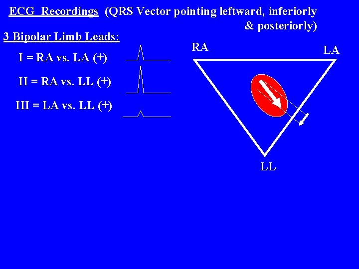 ECG Recordings (QRS Vector pointing leftward, inferiorly & posteriorly) 3 Bipolar Limb Leads: RA