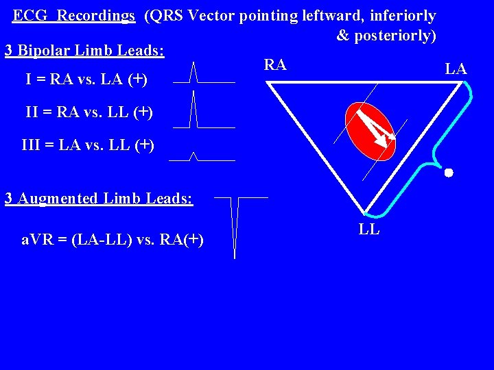 ECG Recordings (QRS Vector pointing leftward, inferiorly & posteriorly) 3 Bipolar Limb Leads: RA