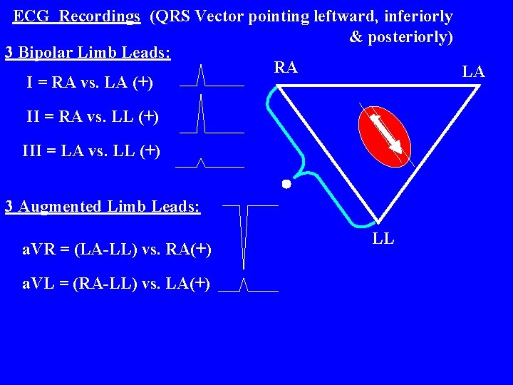 ECG Recordings (QRS Vector pointing leftward, inferiorly & posteriorly) 3 Bipolar Limb Leads: RA