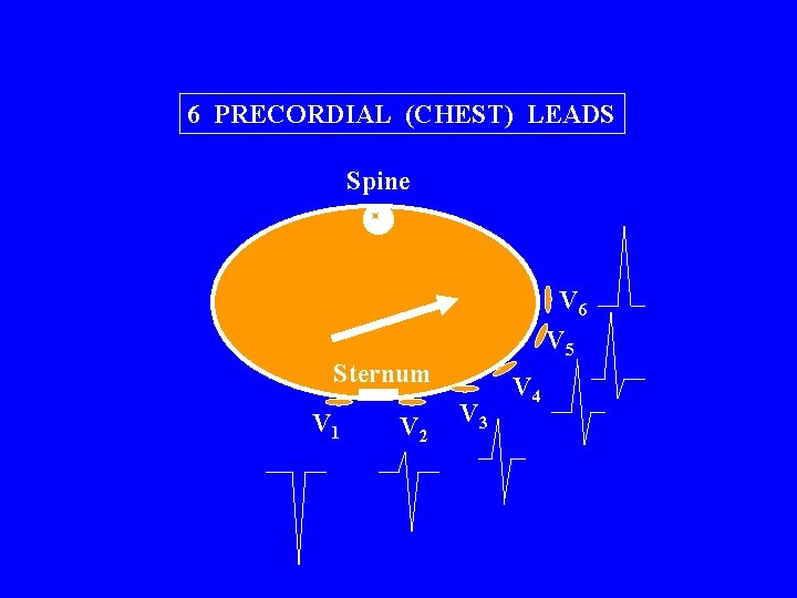 6 PRECORDIAL (CHEST) LEADS Spine V 6 V 5 Sternum V 1 V 2