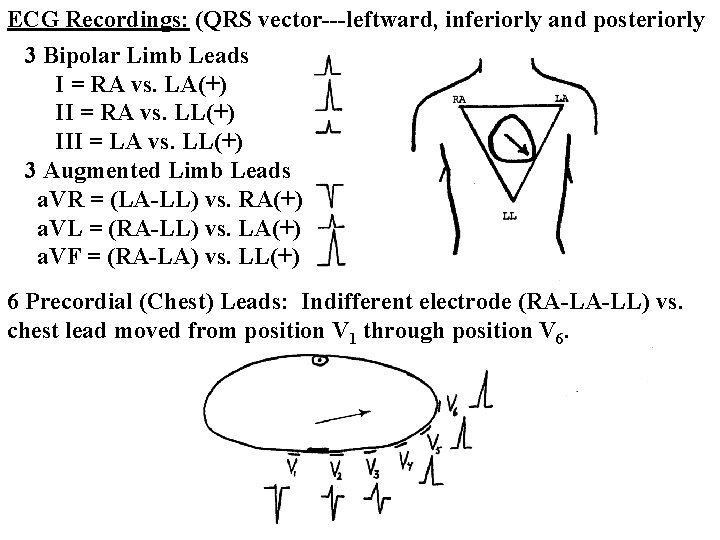 ECG Recordings: (QRS vector---leftward, inferiorly and posteriorly 3 Bipolar Limb Leads I = RA