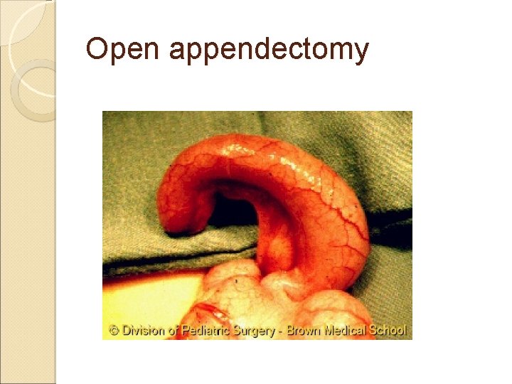 Open appendectomy Open appendectomy
