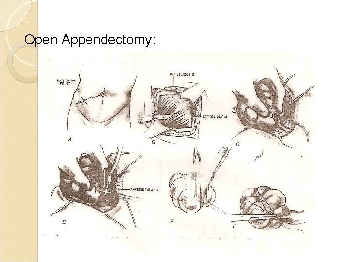 Open Appendectomy: Open Appendectomy: