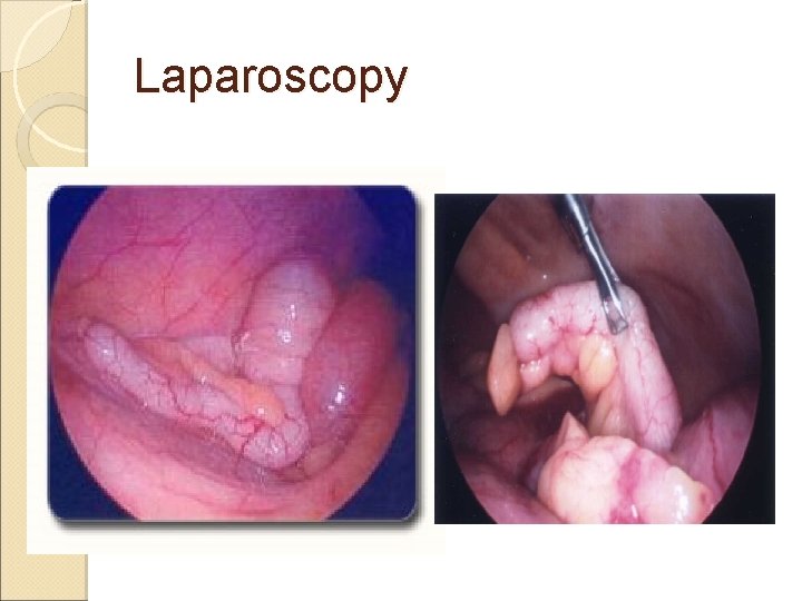 Laparoscopy Laparoscopy