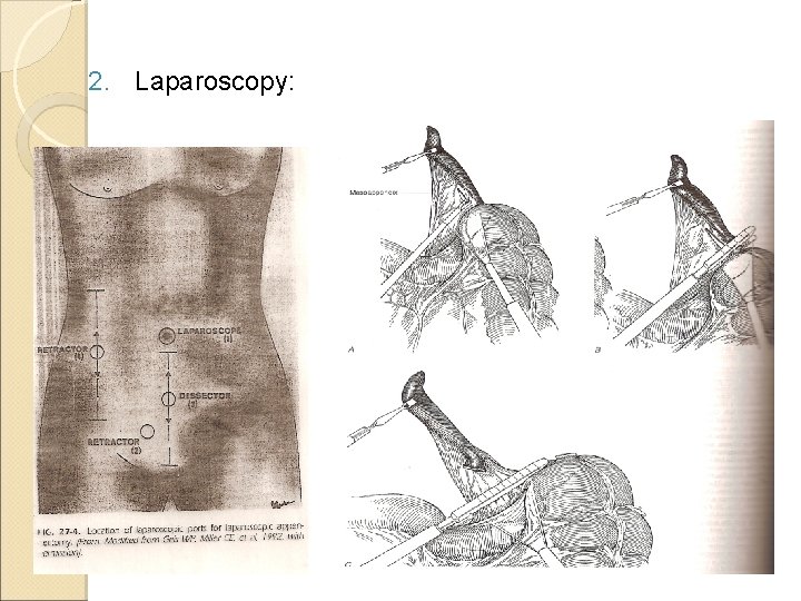 2. Laparoscopy: 2. Laparoscopy: