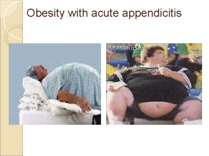 Obesity with acute appendicitis Obesity with acute appendicitis