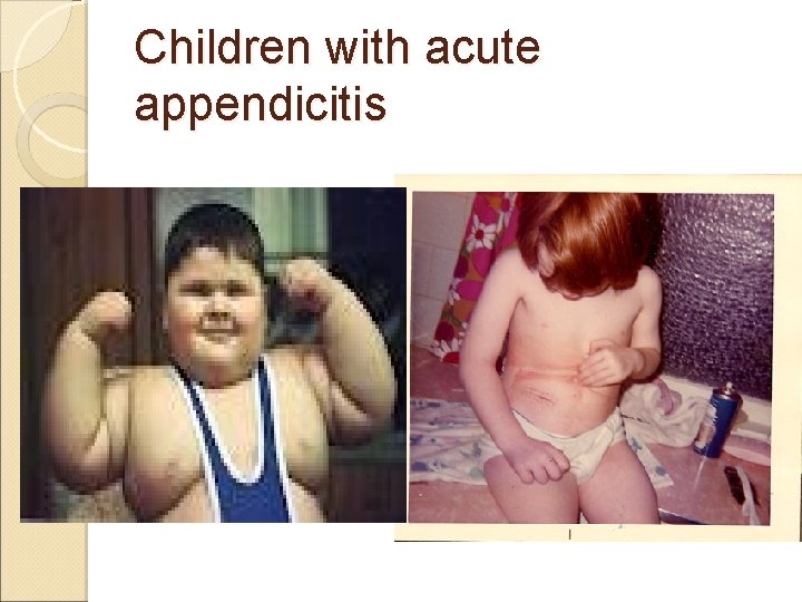 Children with acute appendicitis Children with acute appendicitis
