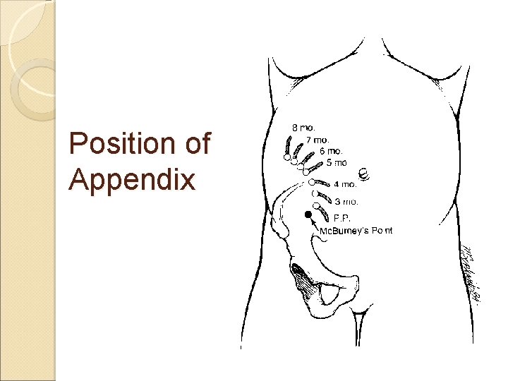 Position of Appendix Position of Appendix