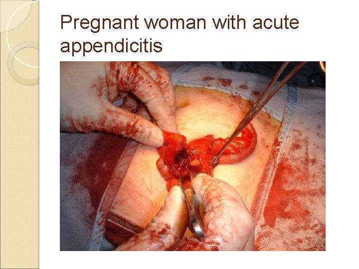 Pregnant woman with acute appendicitis Pregnant woman with acute appendicitis