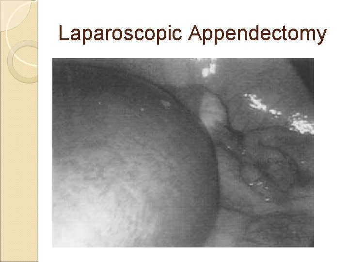 Laparoscopic Appendectomy Laparoscopic Appendectomy