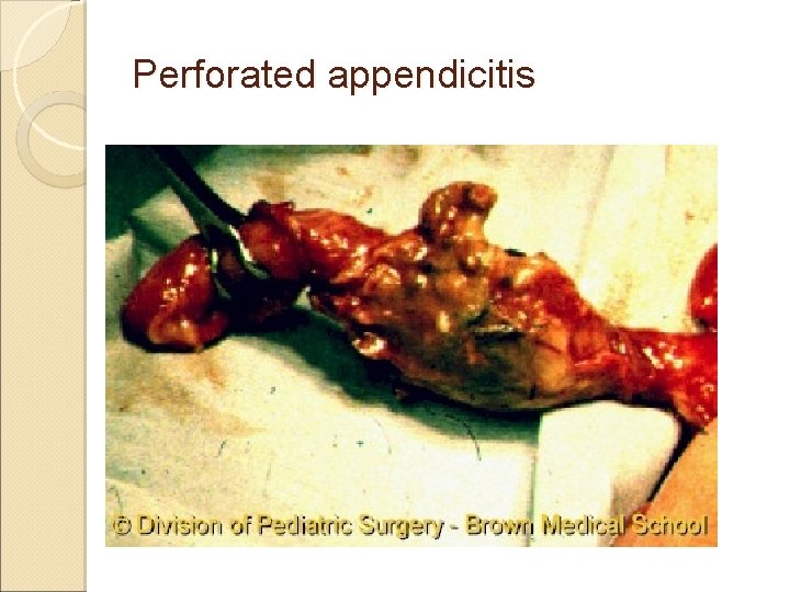Perforated appendicitis Perforated appendicitis