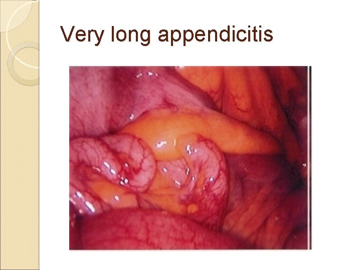 Very long appendicitis Very long appendicitis
