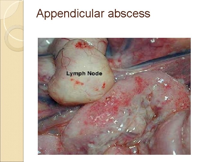 Appendicular abscess Appendicular abscess