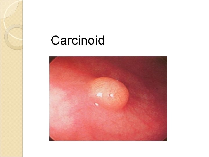 Carcinoid Carcinoid