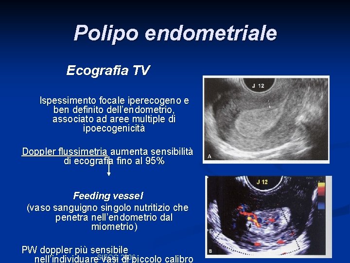 Polipo endometriale Ecografia TV Ispessimento focale iperecogeno e ben definito dell’endometrio, associato ad aree Polipo endometriale Ecografia TV Ispessimento focale iperecogeno e ben definito dell’endometrio, associato ad aree