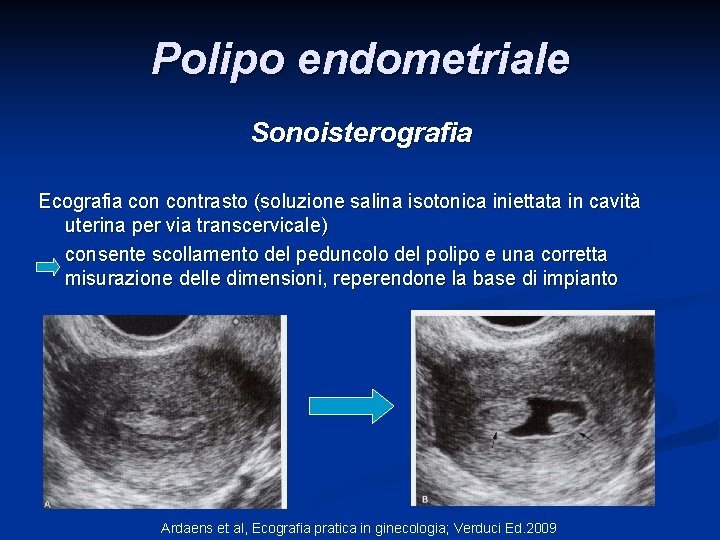 Polipo endometriale Sonoisterografia Ecografia contrasto (soluzione salina isotonica iniettata in cavità uterina per via Polipo endometriale Sonoisterografia Ecografia contrasto (soluzione salina isotonica iniettata in cavità uterina per via