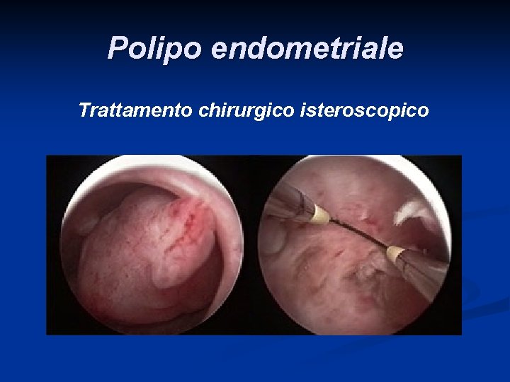 Polipo endometriale Trattamento chirurgico isteroscopico Polipo endometriale Trattamento chirurgico isteroscopico