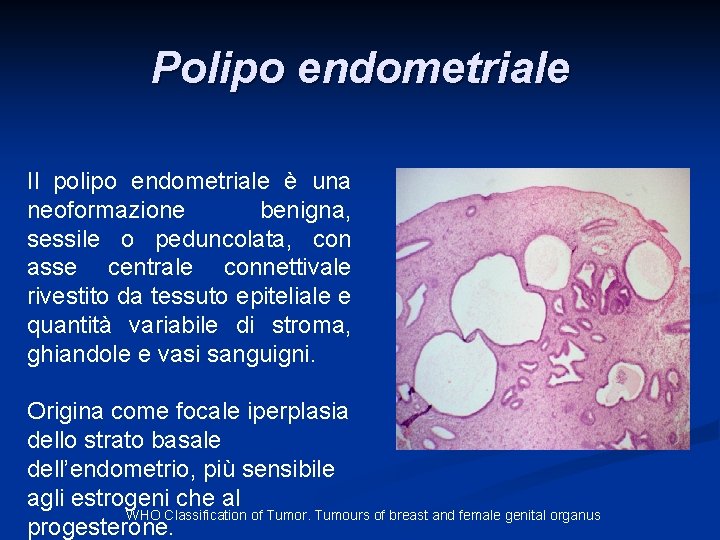 Polipo endometriale Il polipo endometriale è una neoformazione benigna, sessile o peduncolata, con asse Polipo endometriale Il polipo endometriale è una neoformazione benigna, sessile o peduncolata, con asse