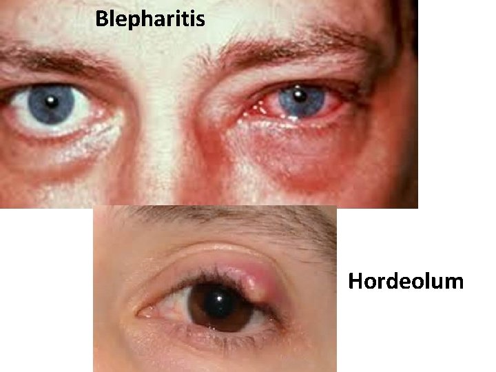 Blepharitis Hordeolum 